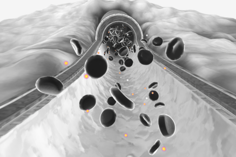 Can Peripheral Artery Disease be Reversed simpleABI Newman Medical