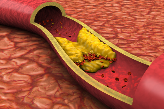 Peripheral Artery Disease 3 Key Aspects Guidelines